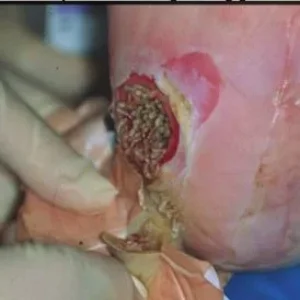 Maggots in wound.jpeg